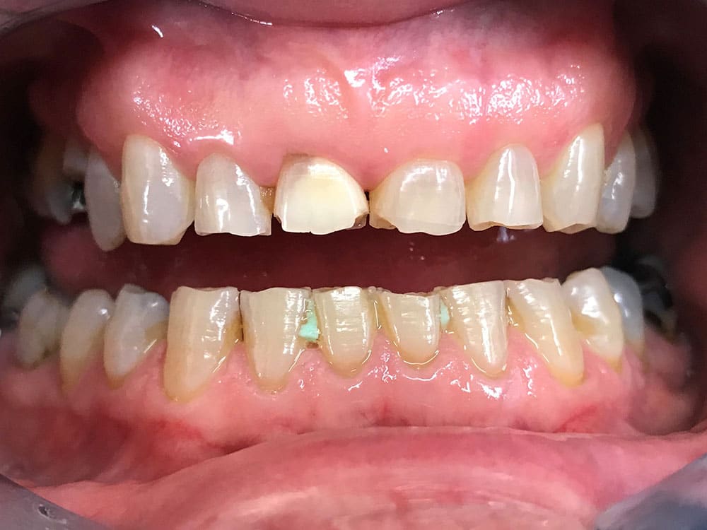 barry-warnes-before-teeth