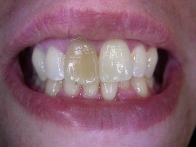 bleach single tooth