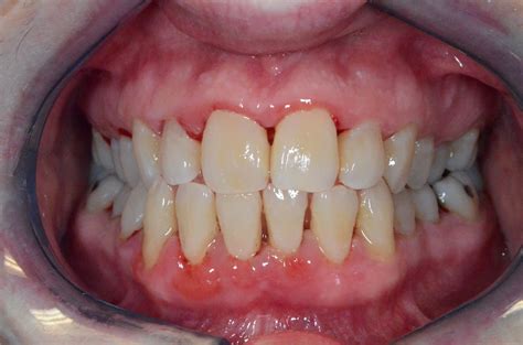 gum disease prevention